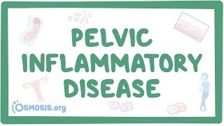 Pelvic inflammatory disease  causes symptoms diagnosis treatment pathology [upl. by Ericksen]