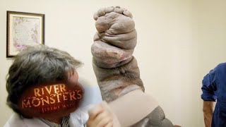 The Miracle Elephantiasis Treatment  HORROR STORY  River Monsters [upl. by Eihpos]