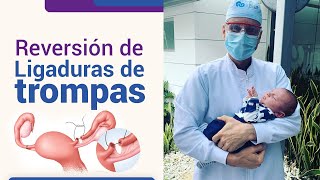 Reversión de la ligadura de trompas l Dr Juan Luis Giraldo [upl. by Nodab618]