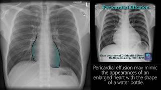 Radiograph Tutorial Chest Xray  CXR  Radiology Nation [upl. by Pavyer]