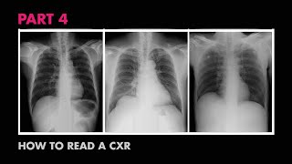 Assessment of CXR Positioning amp Views  How to Read a Chest XRay Part 4  MEDZCOOL [upl. by Abbate]