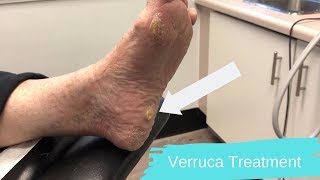 Verruca Pedis  Wart Treatment [upl. by Llertnov]