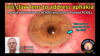 Iris claw lens to address aphakia Artisan IOL Wörst IOL [upl. by Bryce]