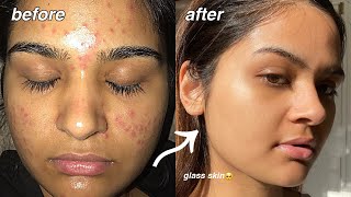 how i cleared my acne FOR GOOD something finally worked [upl. by Irme]