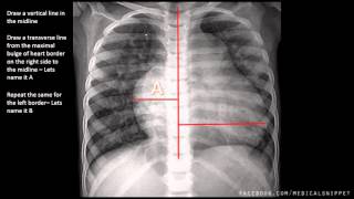 How to measure Cardiomegaly in CXR [upl. by Pelage]