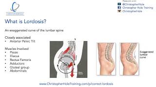 Lordosis Treatment A 3 Step Process [upl. by Aennil]