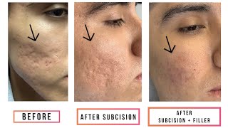 Subcision  Filler for Acne Scars [upl. by Nref]