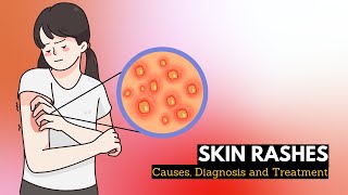 Skin Rash Causes Signs and Symptoms Diagnosis and Treatment [upl. by Christabel278]