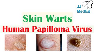 Overview of Skin Warts Verrucae  What Causes Them Who Gets Them  Subtypes and Treatment [upl. by Adnohsel435]