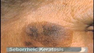 Common Skin Lesions [upl. by Kcirdderf]