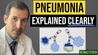 Pneumonia Explained Symptoms Diagnosis Labs Treatment [upl. by Aikal]