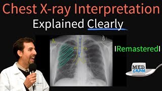 Chest X Ray Interpretation Explained Clearly  How to read a chest Xray [upl. by Lasky]