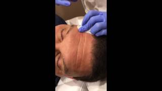 Deep Forehead Lines Removed by Belotero Filler in NYC [upl. by Adnowat]