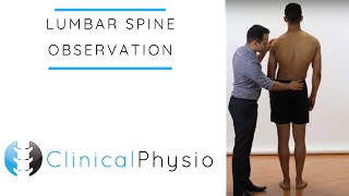 Lumbar Spine Observation  Clinical Physio [upl. by Eatnahc]