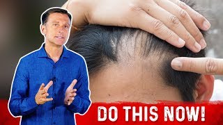 Receding Hairline Causes And Remedies – DrBerg [upl. by Anuska866]