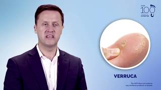 Understand and Manage Wart amp Verruca [upl. by Eesyak233]