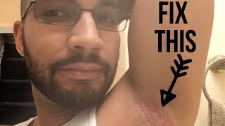 Fix ArmpitHeat Rash From Home [upl. by Mukund]