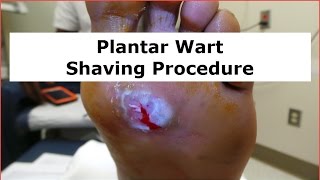 Plantar Wart Shaving Procedure [upl. by Cudlip]