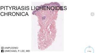 Pityriasis Lichenoides Chronica Dermpath Made Easy [upl. by Adnola]