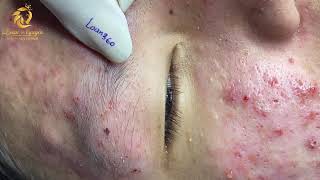 Treatment of acne tablets pustules and blackheads 360  Loan Nguyen [upl. by Ordnajela]